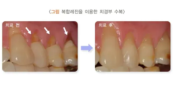 시린이(치아지각과민) 치료 설명 이미지 1