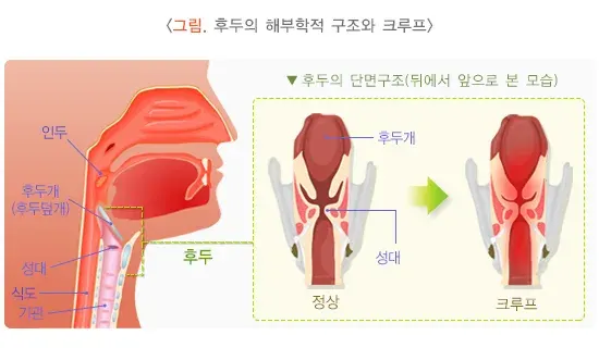 크루프(후두염) 병태생리 설명 이미지 1