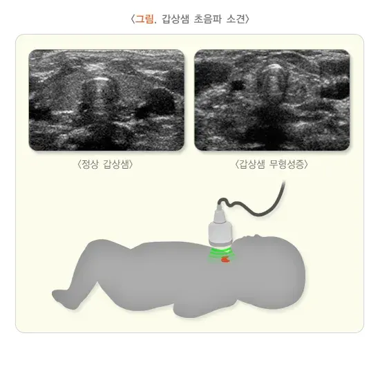 선천갑상샘저하증 진단 및 검사 설명 이미지 1