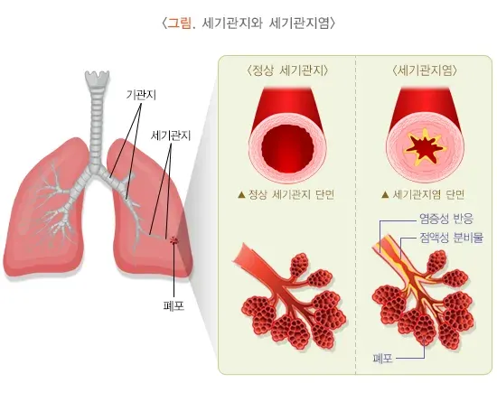 세기관지염 병태생리 설명 이미지 1