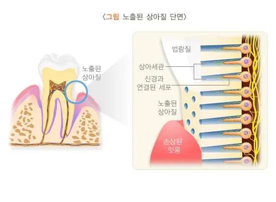 시린이(치아지각과민) 원인 설명 이미지 1