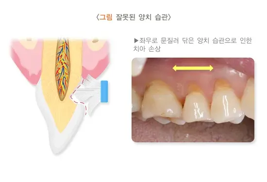 시린이(치아지각과민) 원인 설명 이미지 2