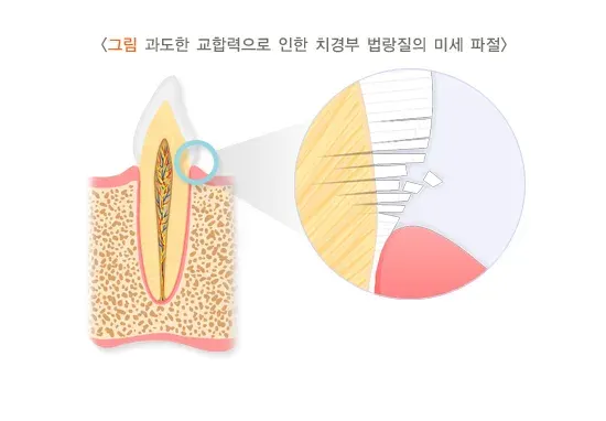 시린이(치아지각과민) 원인 설명 이미지 3