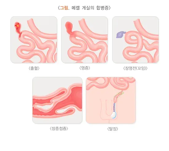 메켈 게실 증상 설명 이미지 1