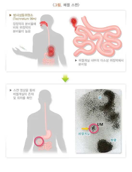 메켈 게실 진단 및 검사 설명 이미지 1