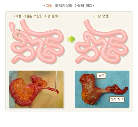 메켈 게실 비약물 치료 설명 이미지 1
