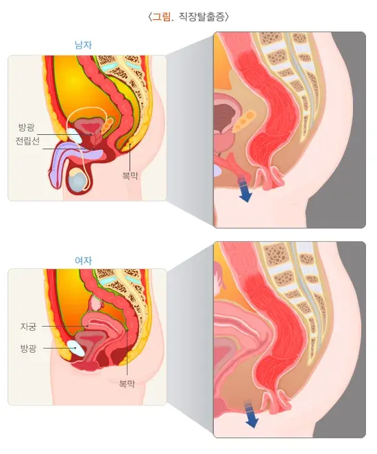 직장탈출증 정의 설명 이미지 1