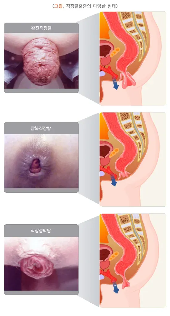 직장탈출증 종류 설명 이미지 1