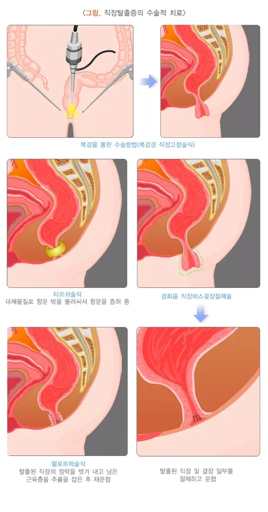 직장탈출증 비약물 치료 설명 이미지 1
