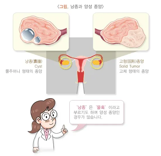 난소 양성 종양 종류 설명 이미지 1