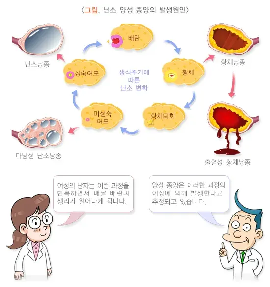 난소 양성 종양 원인 설명 이미지 1