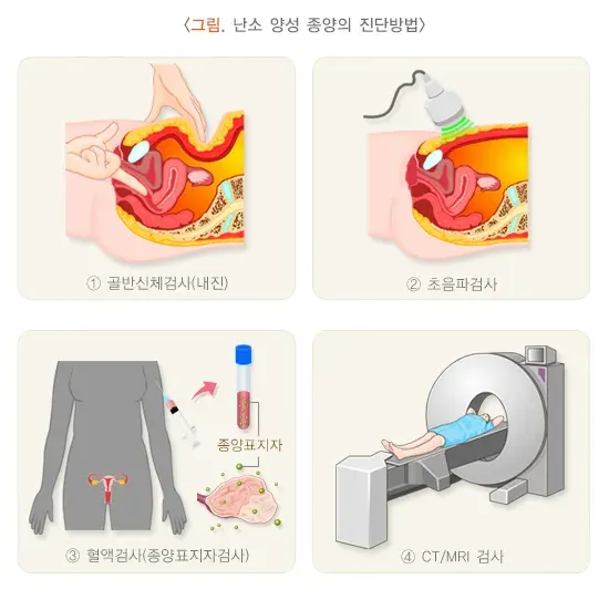 난소 양성 종양 진단 및 검사 설명 이미지 1