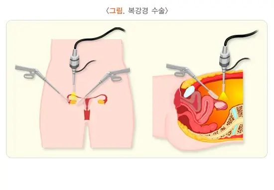 난소 양성 종양 비약물 치료 설명 이미지 1