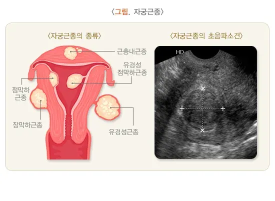 생리통 진단 및 검사 설명 이미지 2