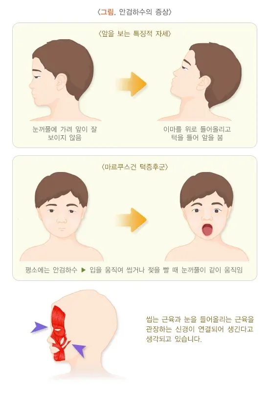 눈꺼풀처짐(안검하수) 증상 설명 이미지 1