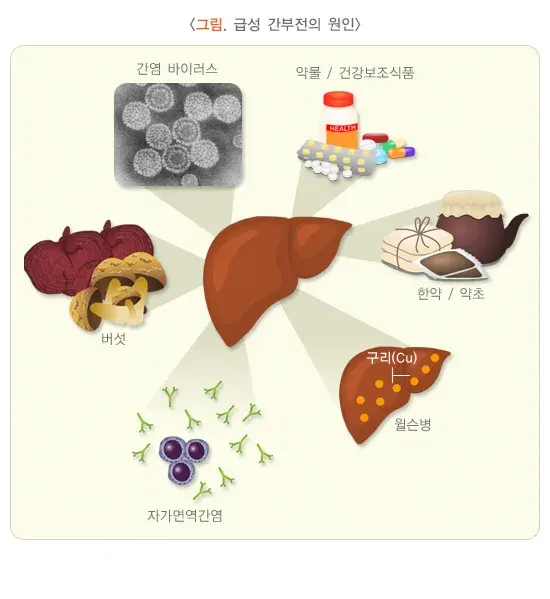 급성 간부전 원인 설명 이미지 1
