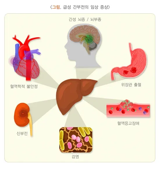 급성 간부전 연관 증상 설명 이미지 1