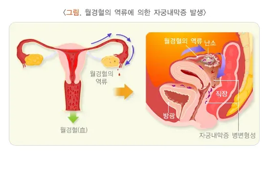 자궁내막증 원인 설명 이미지 1