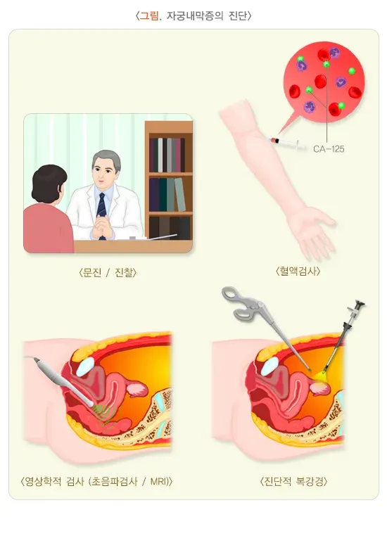 자궁내막증 진단 및 검사 설명 이미지 1