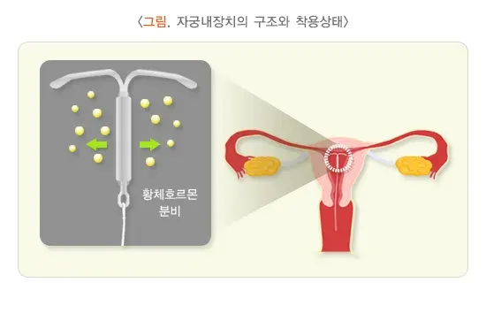 자궁내막증 비약물 치료 설명 이미지 1
