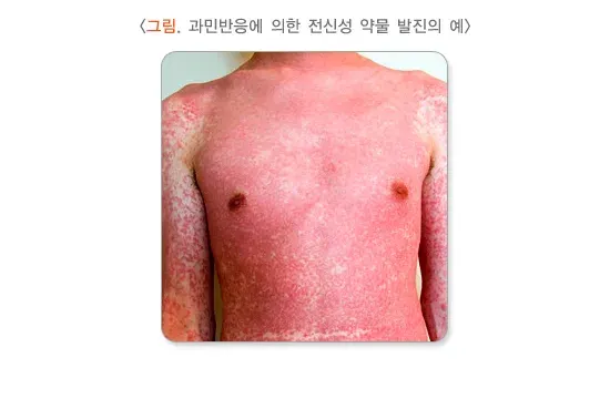항생제 치료 관련 합병증 및 부작용 설명 이미지 1