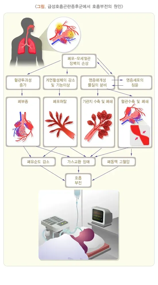 급성호흡곤란증후군 증상 설명 이미지 1