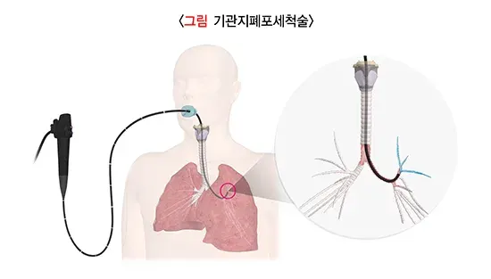 급성호흡곤란증후군 진단 및 검사 설명 이미지 2