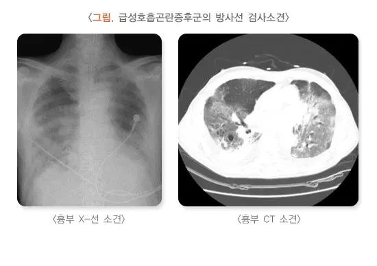 급성호흡곤란증후군 진단 및 검사 설명 이미지 1