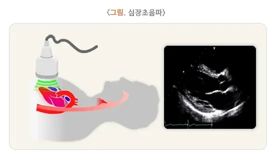 급성호흡곤란증후군 진단 및 검사 설명 이미지 3