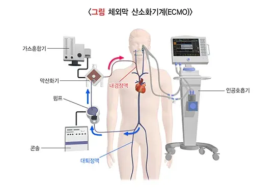 급성호흡곤란증후군 비약물 치료 설명 이미지 3