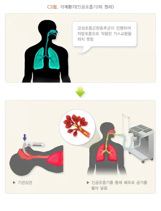 급성호흡곤란증후군 비약물 치료 설명 이미지 1