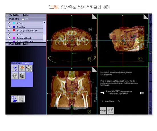 방사선치료 치료 방법 설명 이미지 5