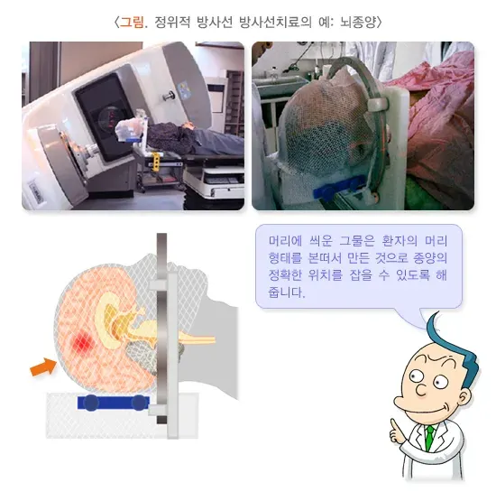 방사선치료 치료 방법 설명 이미지 2
