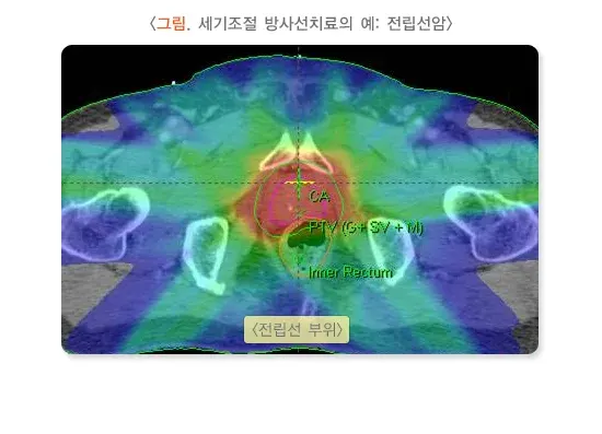 방사선치료 치료 방법 설명 이미지 3