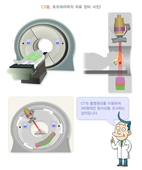 방사선치료 치료 방법 설명 이미지 6