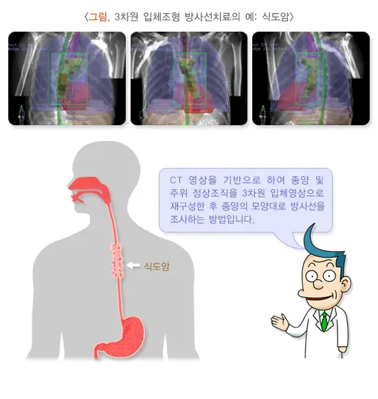 방사선치료 치료 방법 설명 이미지 1