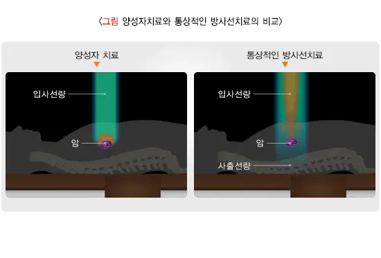 방사선치료 치료 방법 설명 이미지 9
