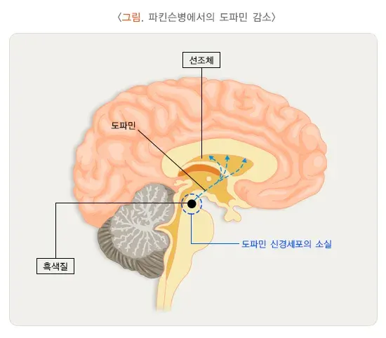 파킨슨병 병태생리 설명 이미지 1