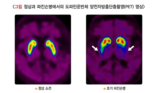파킨슨병 진단 및 검사 설명 이미지 1