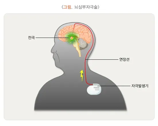 파킨슨병 비약물 치료 설명 이미지 1
