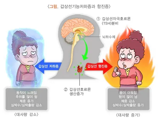 갑상선기능저하증 정의 설명 이미지 1