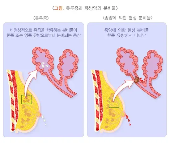 유루증 정의 설명 이미지 1