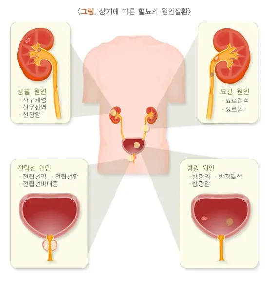 소변이상(혈뇨) 원인 설명 이미지 1