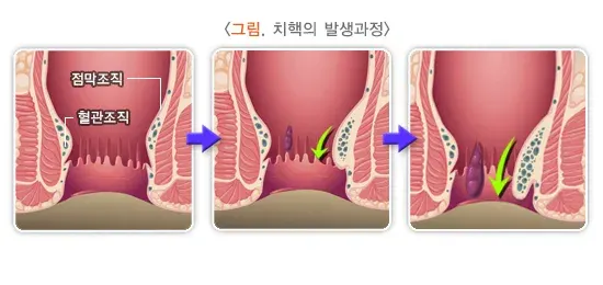 치핵 정의 설명 이미지 1