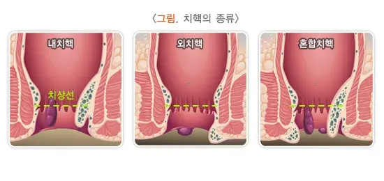치핵 종류 설명 이미지 1