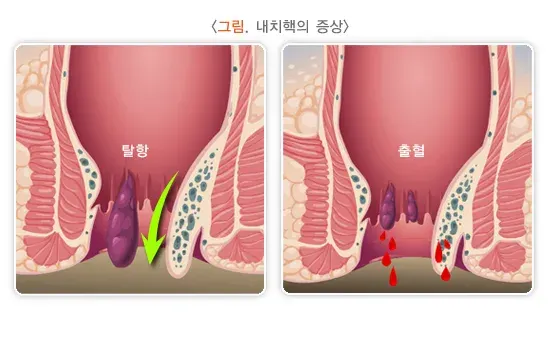치핵 증상 설명 이미지 1