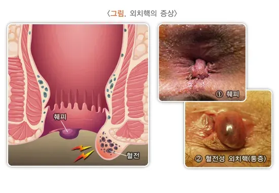 치핵 증상 설명 이미지 2