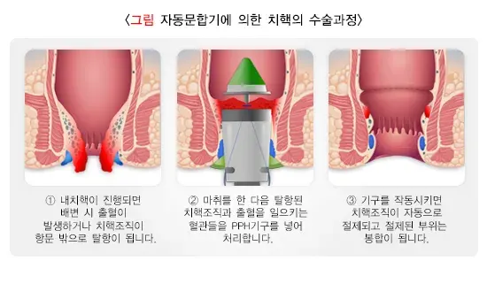 치핵 비약물 치료 설명 이미지 2