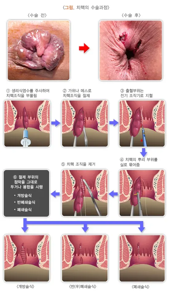 치핵 비약물 치료 설명 이미지 1