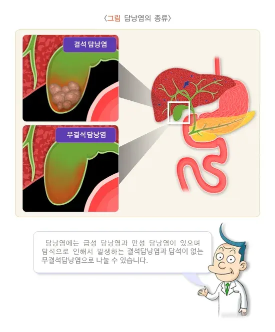담낭염 종류 설명 이미지 1